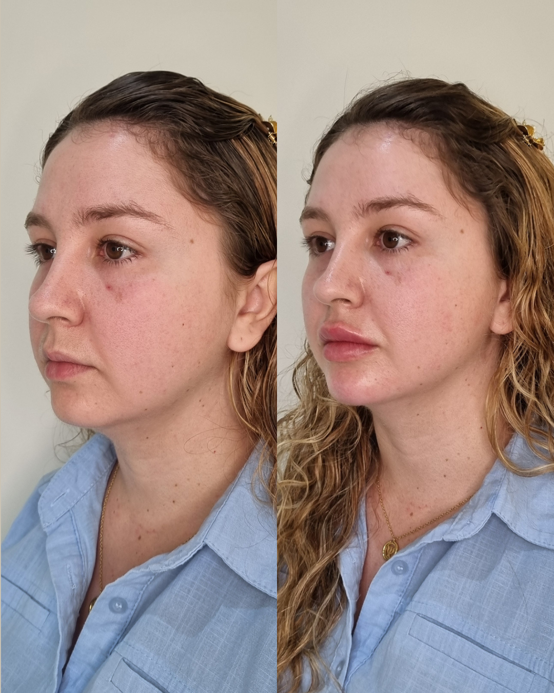 Onde Fazer Harmonização Facial Sem Exagero em Jaraguá do Sul - SC | Padma Onde Fazer Harmonização Facial Sem Exagero em Jaraguá do Sul - SC | Padma