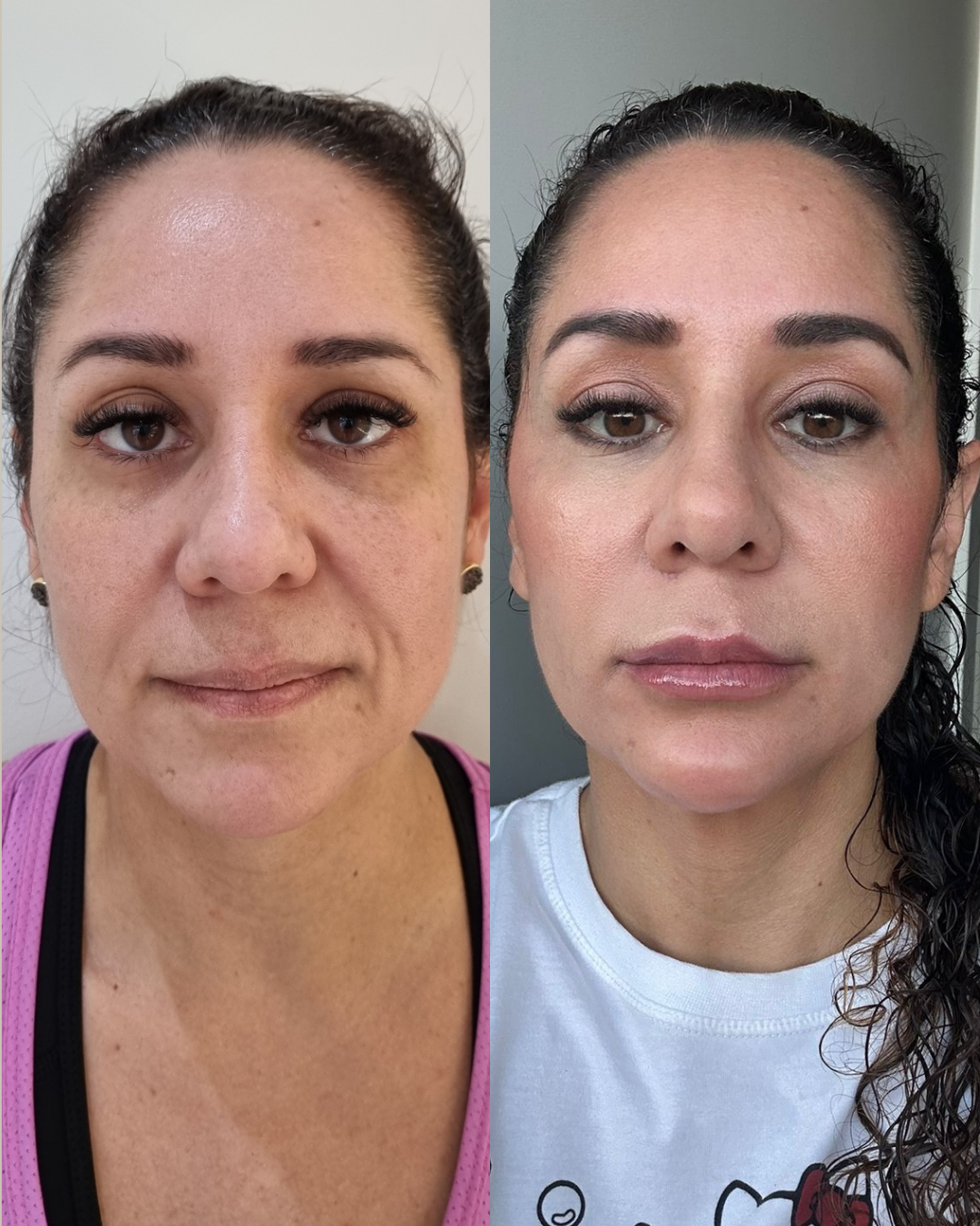 Onde Fazer Harmonização Facial Sem Exagero em Jaraguá do Sul - SC | Padma Onde Fazer Harmonização Facial Sem Exagero em Jaraguá do Sul - SC | Padma
