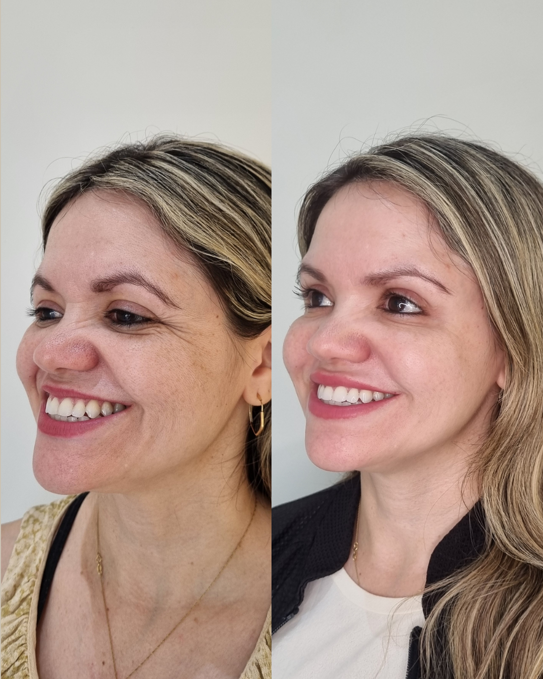 Onde Fazer Harmonização Facial Sem Exagero em Jaraguá do Sul - SC | Padma Onde Fazer Harmonização Facial Sem Exagero em Jaraguá do Sul - SC | Padma