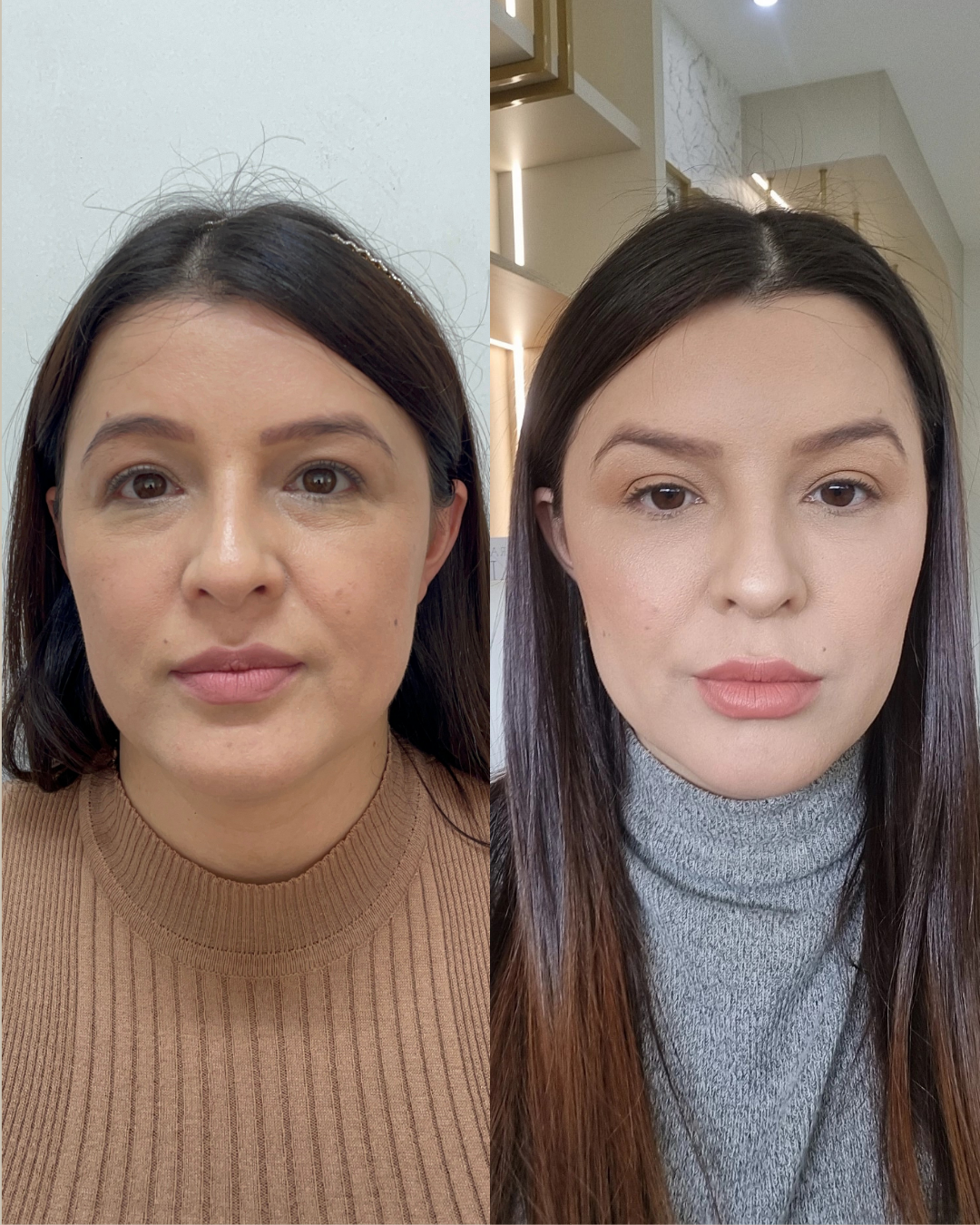 Onde Fazer Harmonização Facial Sem Exagero em Jaraguá do Sul - SC | Padma Onde Fazer Harmonização Facial Sem Exagero em Jaraguá do Sul - SC | Padma