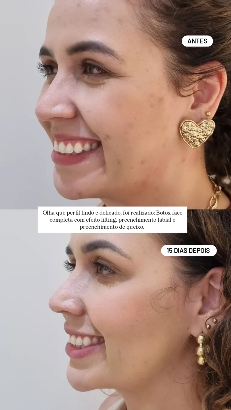 Botox para Sorriso Gengival em Jaraguá do Sul | Padma Essential Clinic