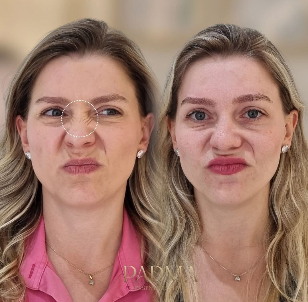Especialista em Botox no Centro de Jaraguá do Sul - SC | Padma Essential Clinic
