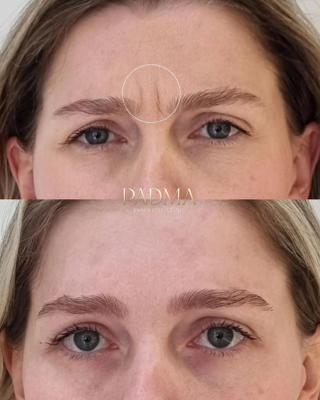Especialista em Botox no Centro de Jaraguá do Sul - SC | Padma Essential Clinic