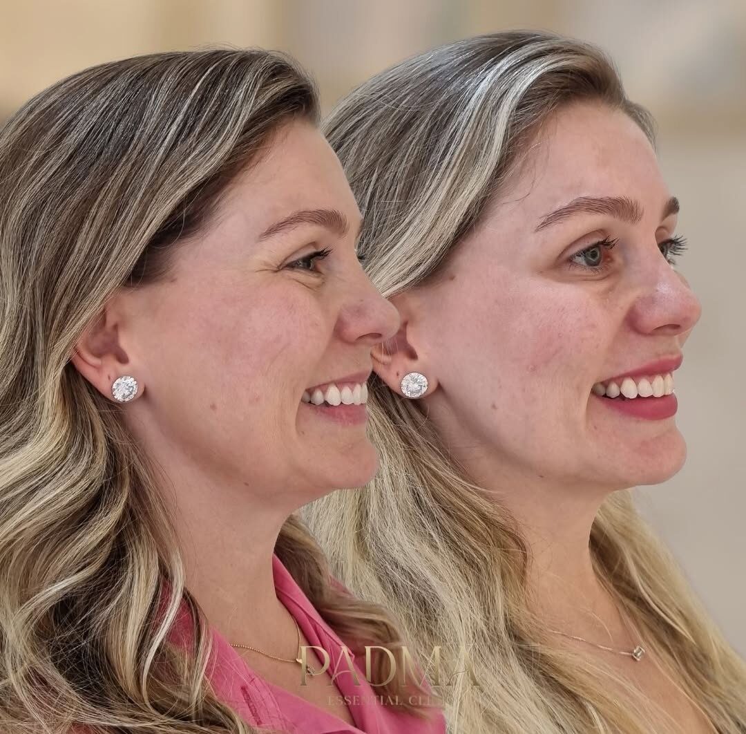 Especialista em Botox no Centro de Jaraguá do Sul - SC | Padma Essential Clinic