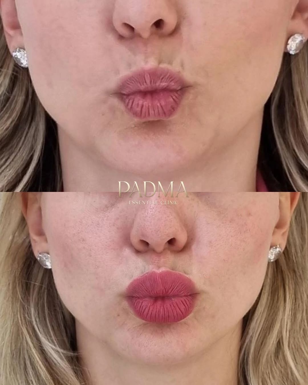 Especialista em Botox no Centro de Jaraguá do Sul - SC | Padma Essential Clinic