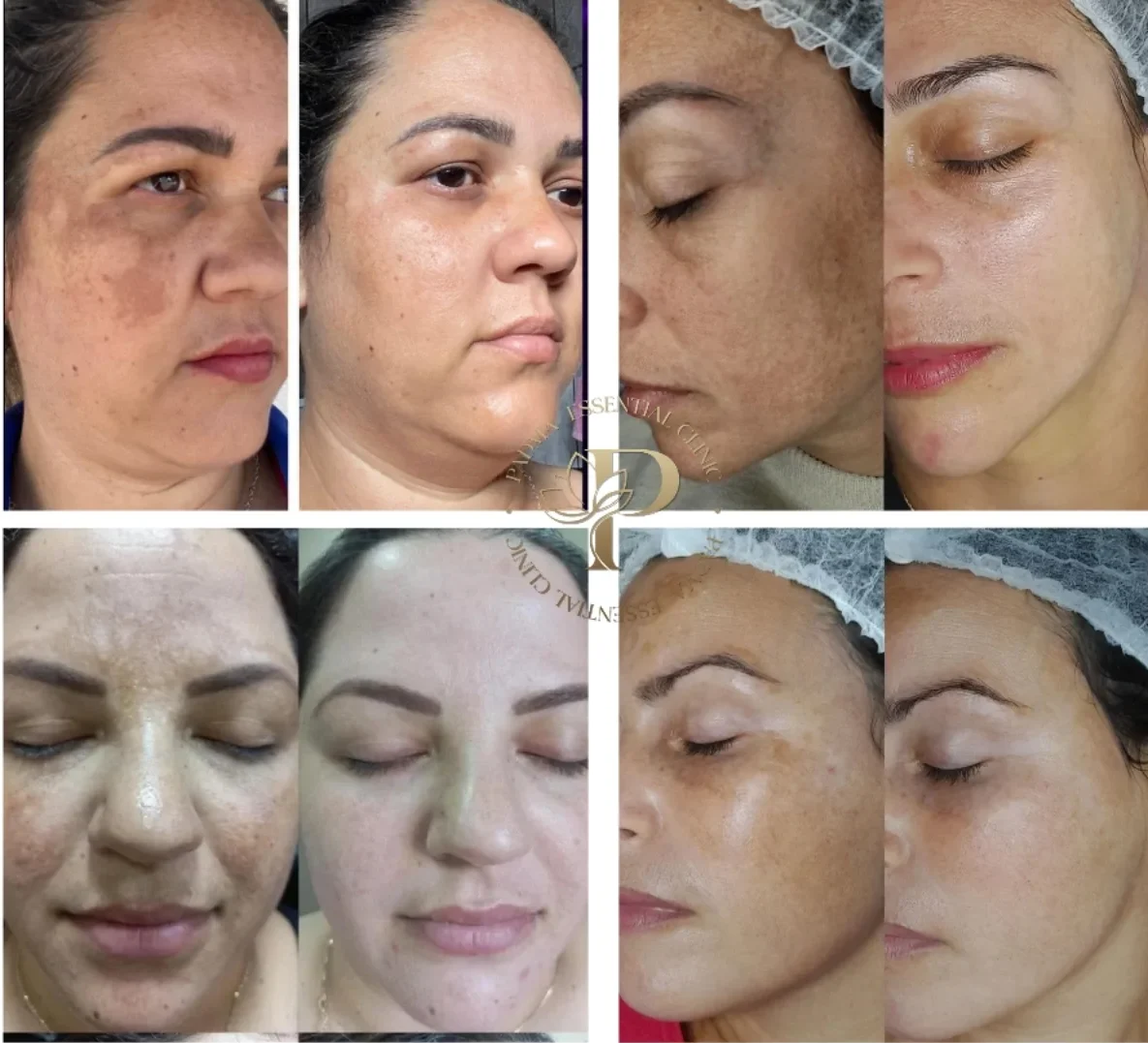 Tratamento para Melasma e Manchas de Sol no Centro de Jaraguá do Sul - SC | Padma