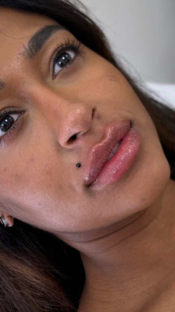 Preenchimento labial