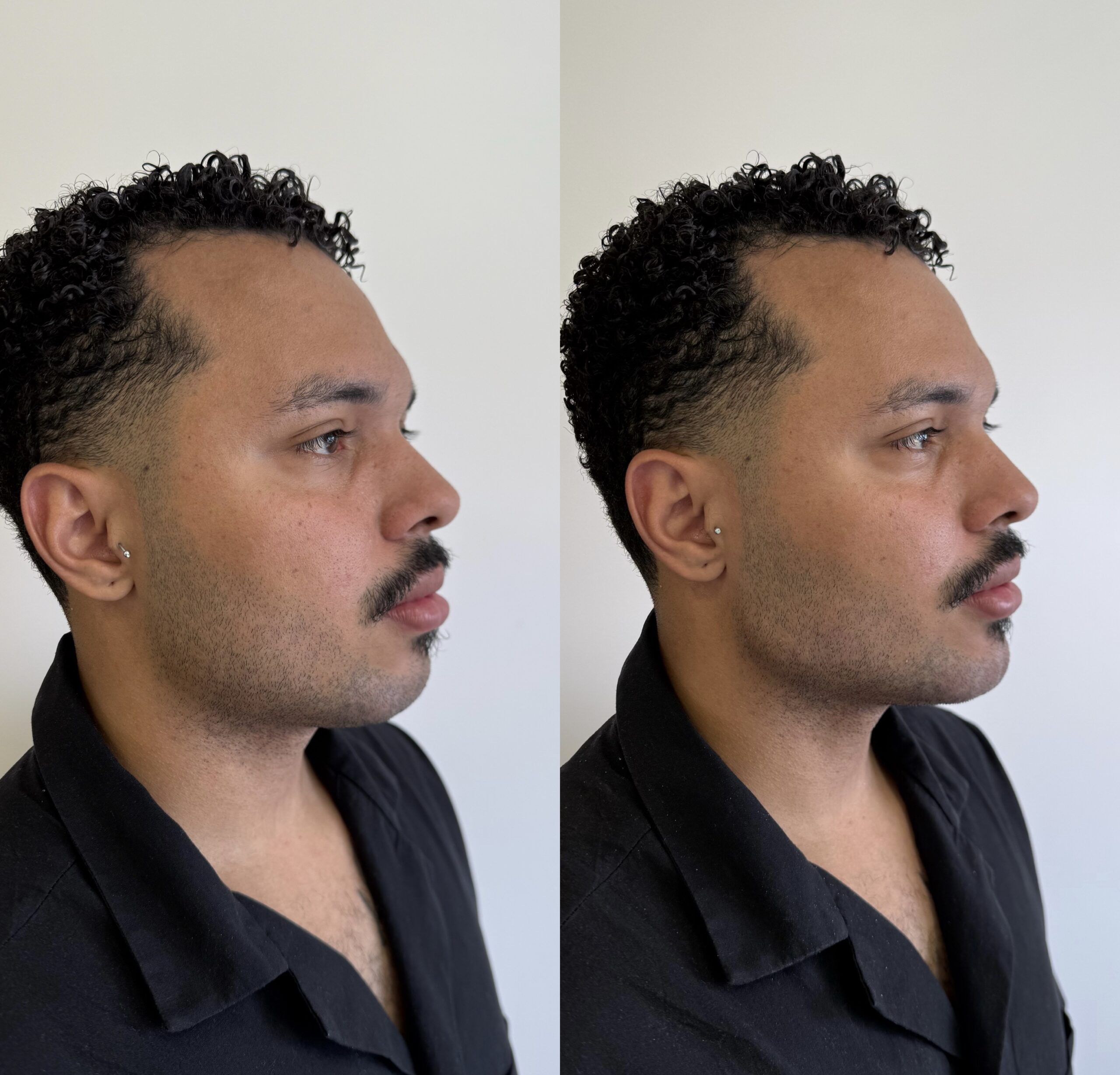 Harmonização Facial Natural em Jaraguá do Sul - SC: Como Realçar Sem Perder Identidade | Padma Essential Clinic Clínica de Estética