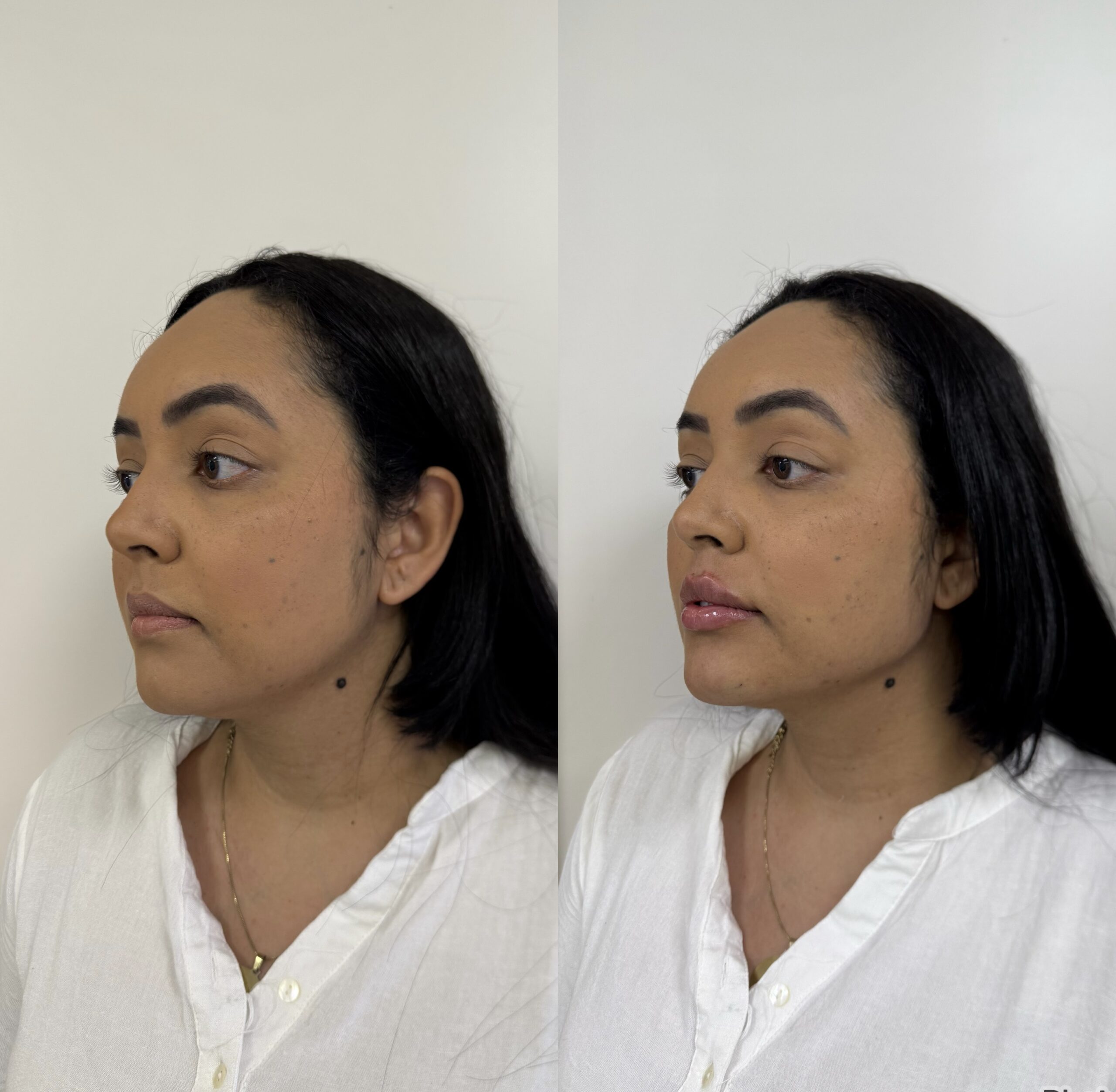 Harmonização Facial Natural em Jaraguá do Sul - SC: Como Realçar Sem Perder Identidade | Padma Essential Clinic Clínica de Estética