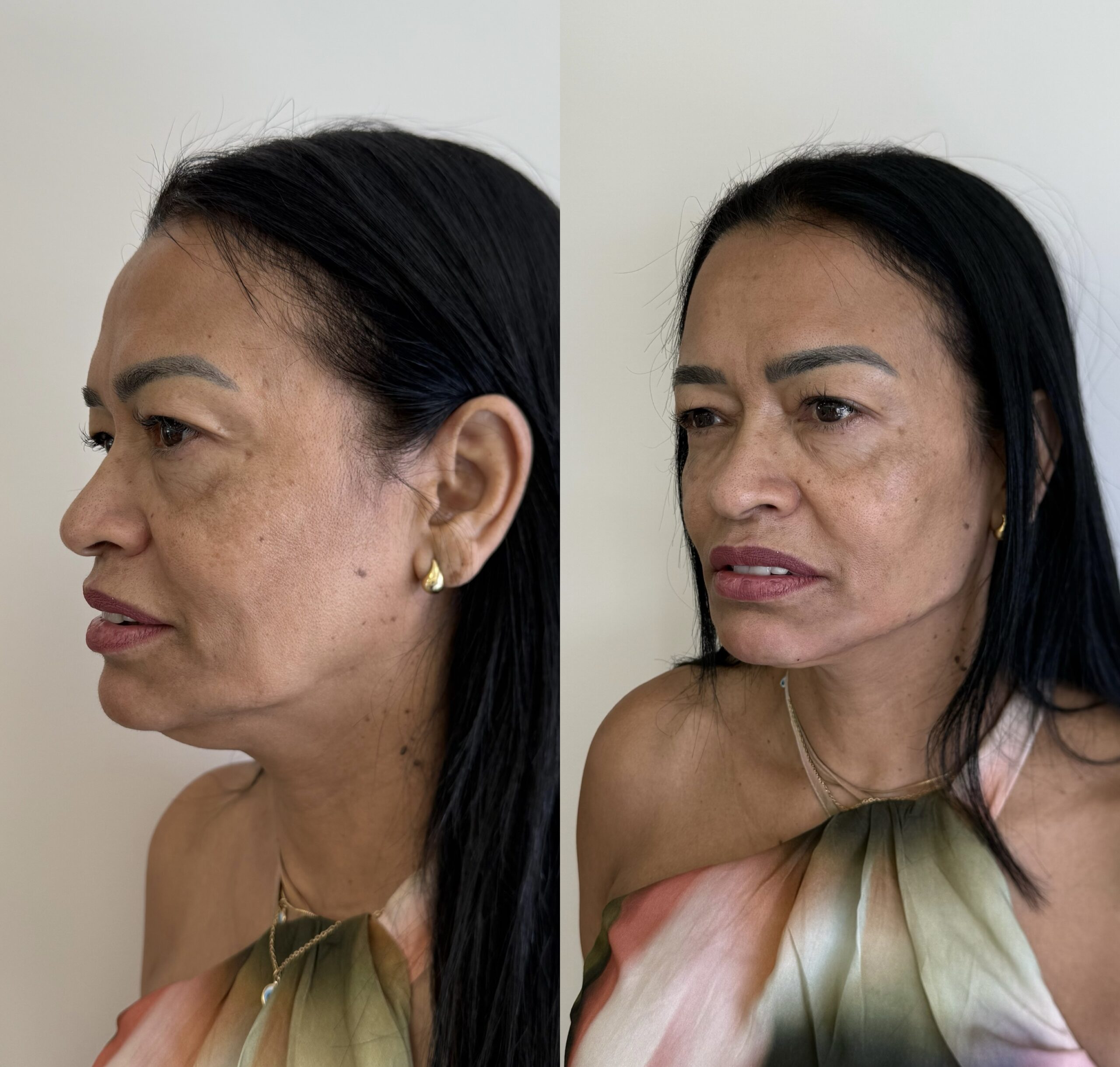 Harmonização Facial Natural em Jaraguá do Sul - SC: Como Realçar Sem Perder Identidade | Padma Essential Clinic Clínica de Estética