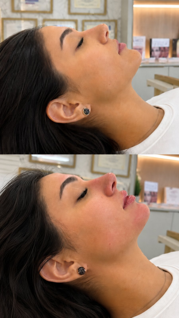 Perfiloplastia