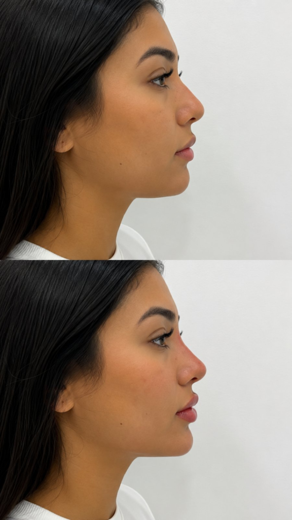 Perfiloplastia
