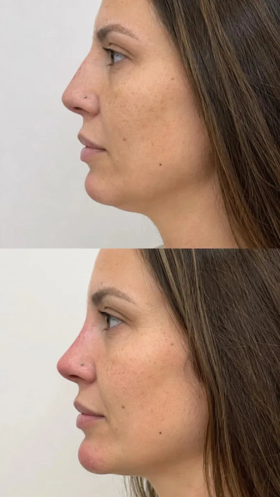 Perfiloplastia